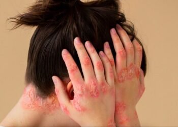 Ilustrasi Orang Terkena Penyakit Kusta