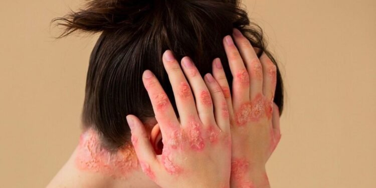 Ilustrasi Orang Terkena Penyakit Kusta