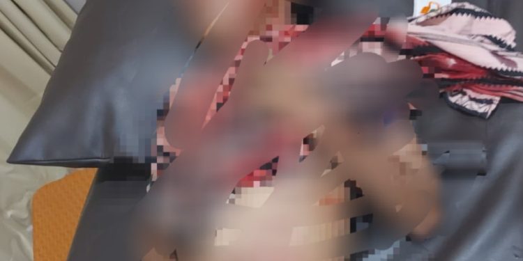 Kondisi bocah 12 tahun akibat digigit buaya dibawah ke RS PKT untuk dirawat